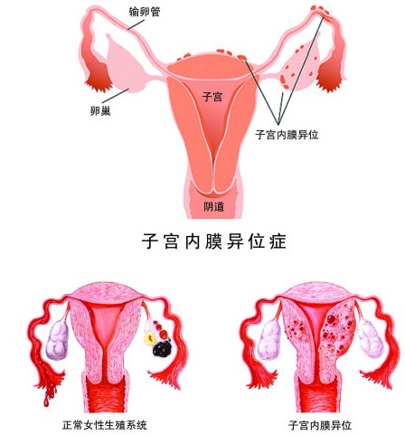 子宫内膜异位症引起女性不孕的原因